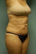 Abdominoplasty