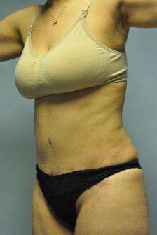 Abdominoplasty Case 5379 After Photo Abdominoplasty