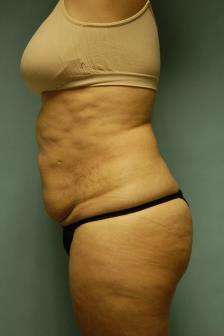 Abdominoplasty Case 5379 Before Photo Abdominoplasty