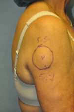 Minimal Incision and Power-assisted Liposuction Removal of Lipomas