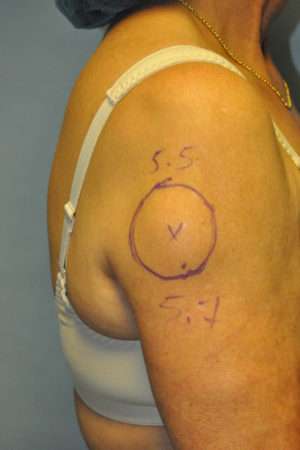 Minimal Incision and Power-assisted Liposuction Removal of Lipomas