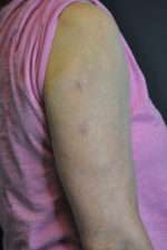 Minimal Incision and Power-assisted Liposuction Removal of Lipomas