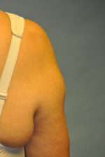 Minimal Incision and Power-assisted Liposuction Removal of Lipomas
