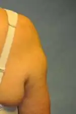 Minimal Incision and Power-assisted Liposuction Removal of Lipomas