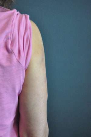 Minimal Incision and Power-assisted Liposuction Removal of Lipomas