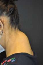 Minimal Incision and Power-assisted Liposuction Removal of Lipomas