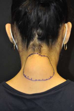 Minimal Incision and Power-assisted Liposuction Removal of Lipomas
