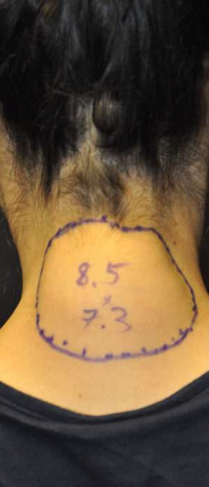 Minimal Incision and Power-assisted Liposuction Removal of Lipomas