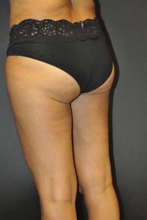 Cellulaze Anti-cellulite Treatment