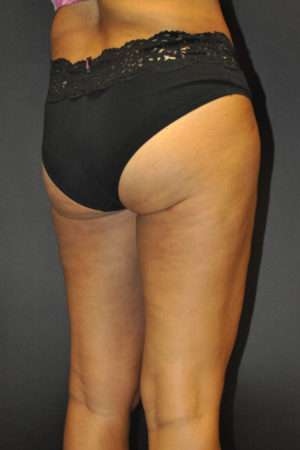 Cellulaze Anti-cellulite Treatment