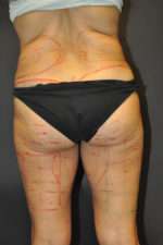Cellulaze Anti-cellulite Treatment