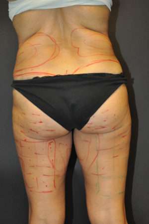 Cellulaze Anti-cellulite Treatment
