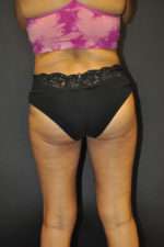 Cellulaze Anti-cellulite Treatment