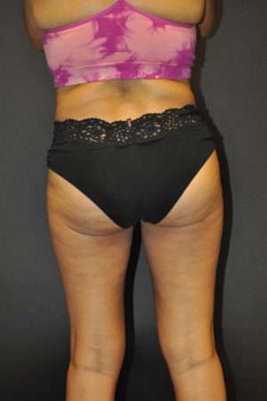 Cellulaze Anti-cellulite Treatment