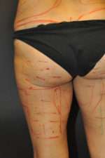 Cellulaze Anti-cellulite Treatment