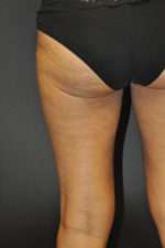 Cellulaze Anti-cellulite Treatment