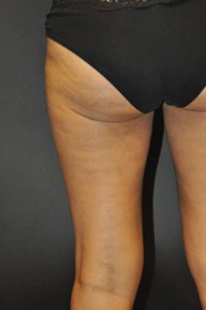 Cellulaze Anti-cellulite Treatment