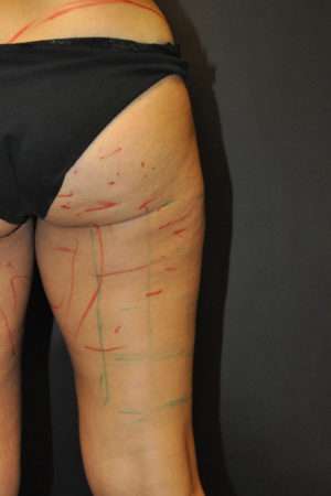 Cellulaze Anti-cellulite Treatment