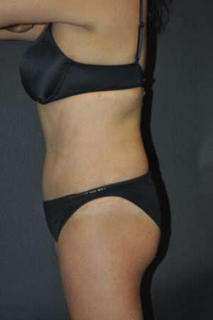 Abdominoplasty