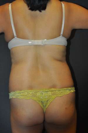 Abdominoplasty