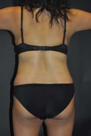 Abdominoplasty