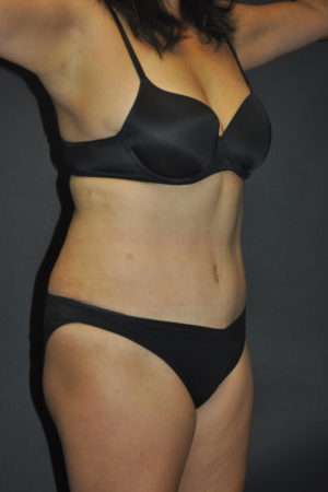 Abdominoplasty