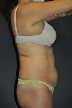 Abdominoplasty