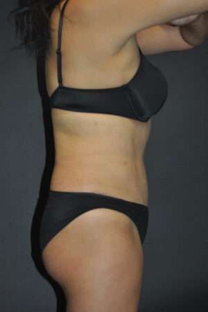Abdominoplasty