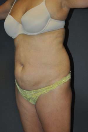Abdominoplasty