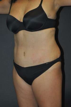 Abdominoplasty