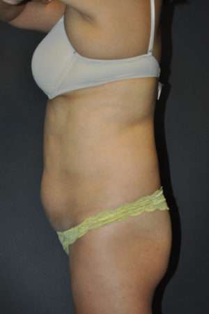 Abdominoplasty
