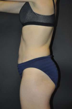 Abdominoplasty