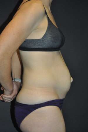 Abdominoplasty