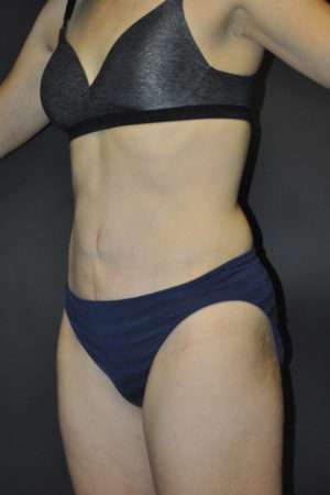 Abdominoplasty