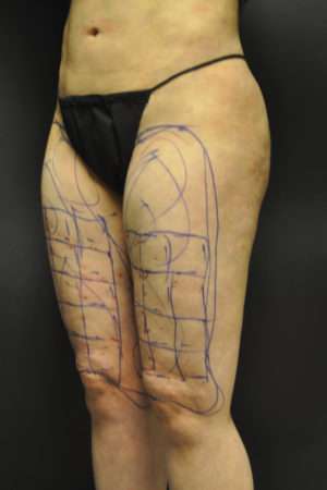 Cellulaze Anti-cellulite Treatment