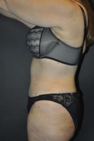Abdominoplasty