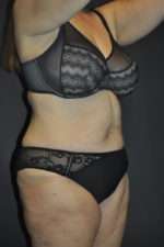 Abdominoplasty