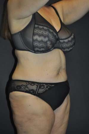 Abdominoplasty