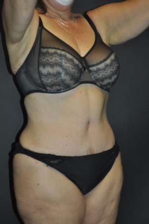 Abdominoplasty