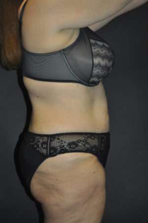 Abdominoplasty