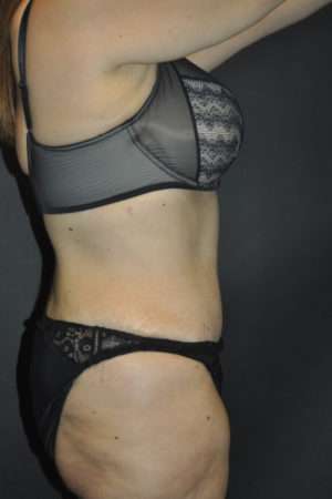 Abdominoplasty