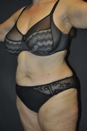 Abdominoplasty