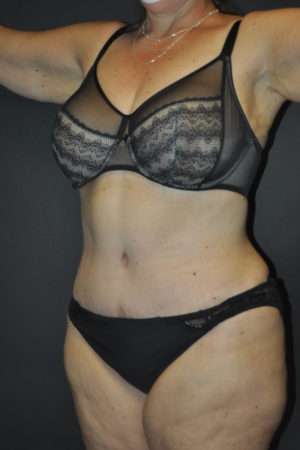 Abdominoplasty