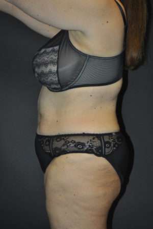 Abdominoplasty