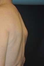 Minimal Incision and Power-assisted Liposuction Removal of Lipomas