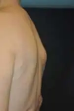 Minimal Incision and Power-assisted Liposuction Removal of Lipomas