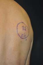 Minimal Incision and Power-assisted Liposuction Removal of Lipomas