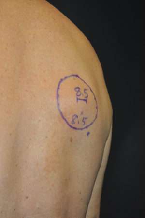 Minimal Incision and Power-assisted Liposuction Removal of Lipomas