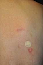 Minimal Incision and Power-assisted Liposuction Removal of Lipomas