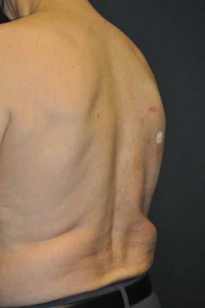 Minimal Incision and Power-assisted Liposuction Removal of Lipomas